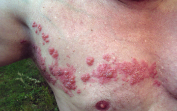 http://pl.wikipedia.org/wiki/Plik:Herpes_zoster_chest.png, użytkownik: Fisle